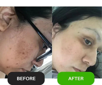 Wiki Clear & Glow Duo | Anti-Acne Serum + Beauty Cream