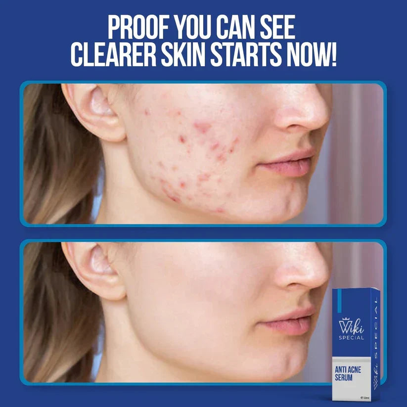 Wiki Special Anti Acne Serum- 30 ml  | Buy 1 Get 1 Free