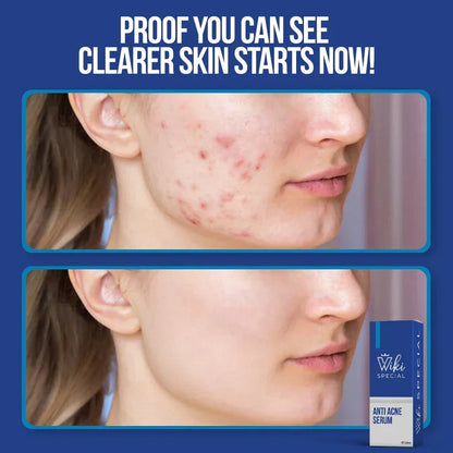 Wiki Special Anti Acne Serum- 30 ml  | Buy 1 Get 1 Free